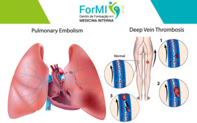 2ª edição do Curso de Tromboembolismo Venoso e Ecodoppler Venoso dos Membros Inferiores – Abertas as Inscrições